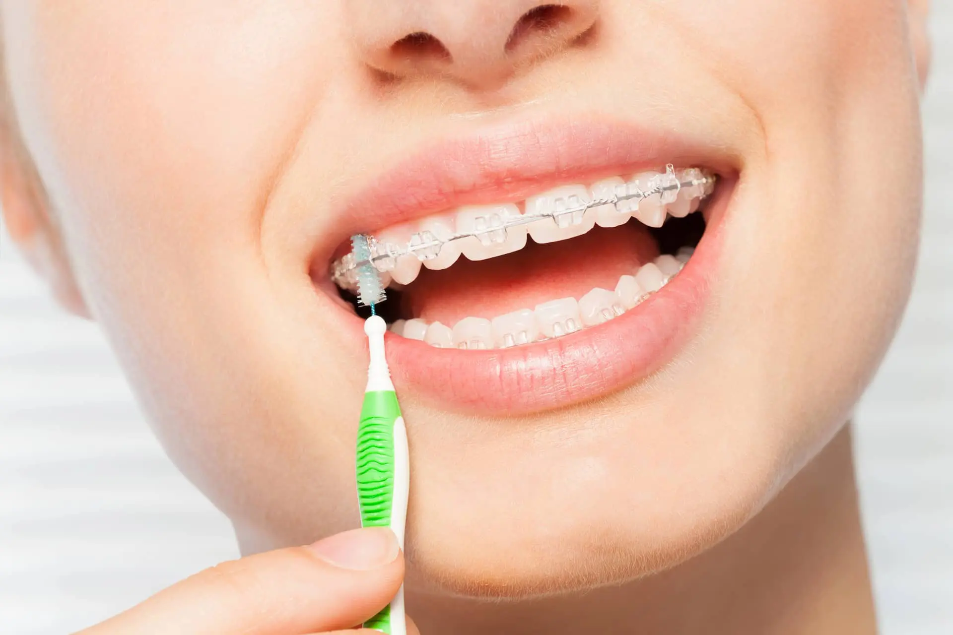 A person cleans braces using an interdental brush, demonstrating proper care for clear braces in Jacksonville, FL.