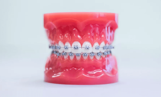 Dental model showing a full set of teeth with metal braces on both the upper and lower jaws against a plain background in Jacksonville, FL.