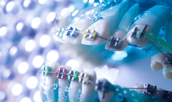 Close-up of a dental model showcasing teeth with colorful metal braces, illuminated against a blurred background in Jacksonville, FL.