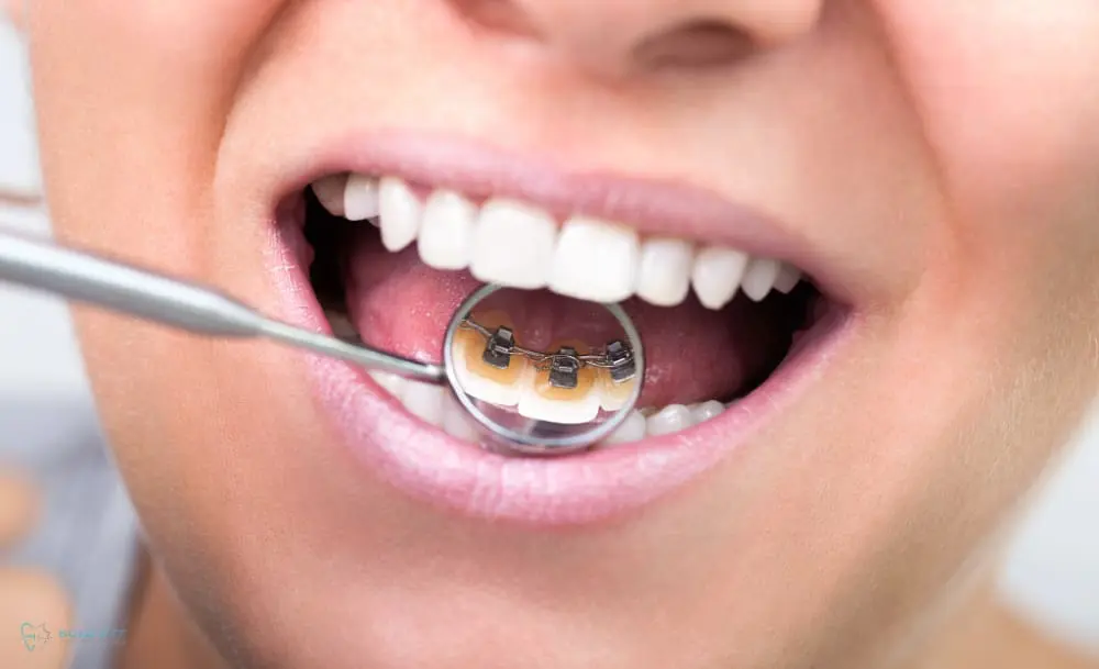 Close-up of a mouth with a dental mirror showing braces on the inner side of the teeth as one of the alternatives to braces in Jacksonville, FL, with a dental tool holding the cheek open.