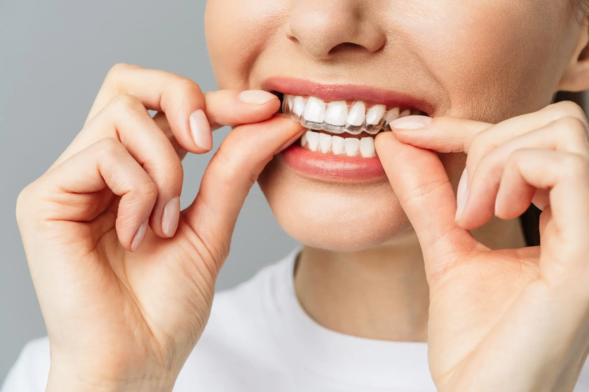 A person placing a clear dental aligner over their upper teeth, demonstrating the easy, discreet alternative when considering Invisalign vs Braces in Jacksonville FL.