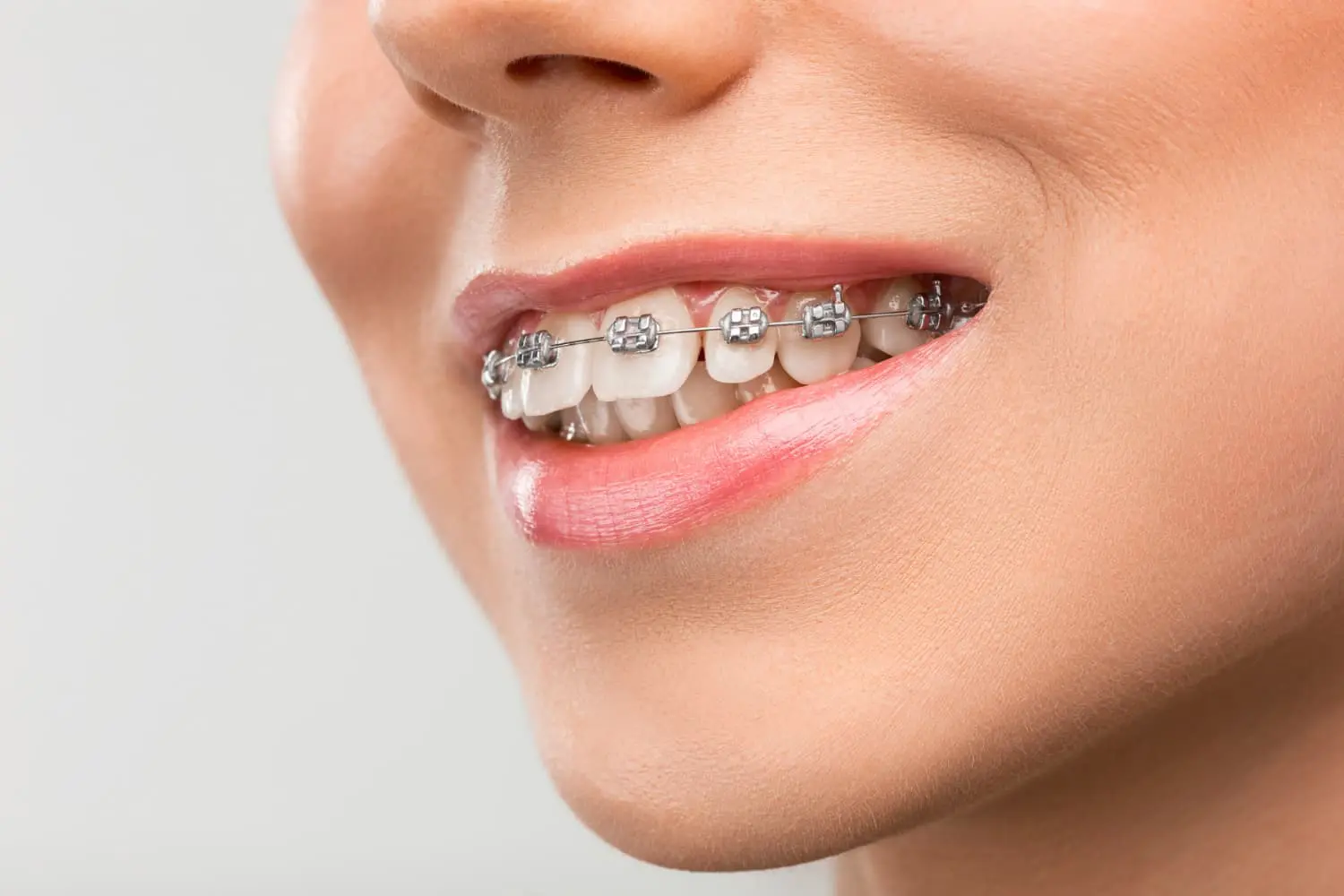 Close-up of a person smiling, clearly showing metal dental braces on their teeth and a noticeable overbite. This image was taken in Jacksonville, FL.