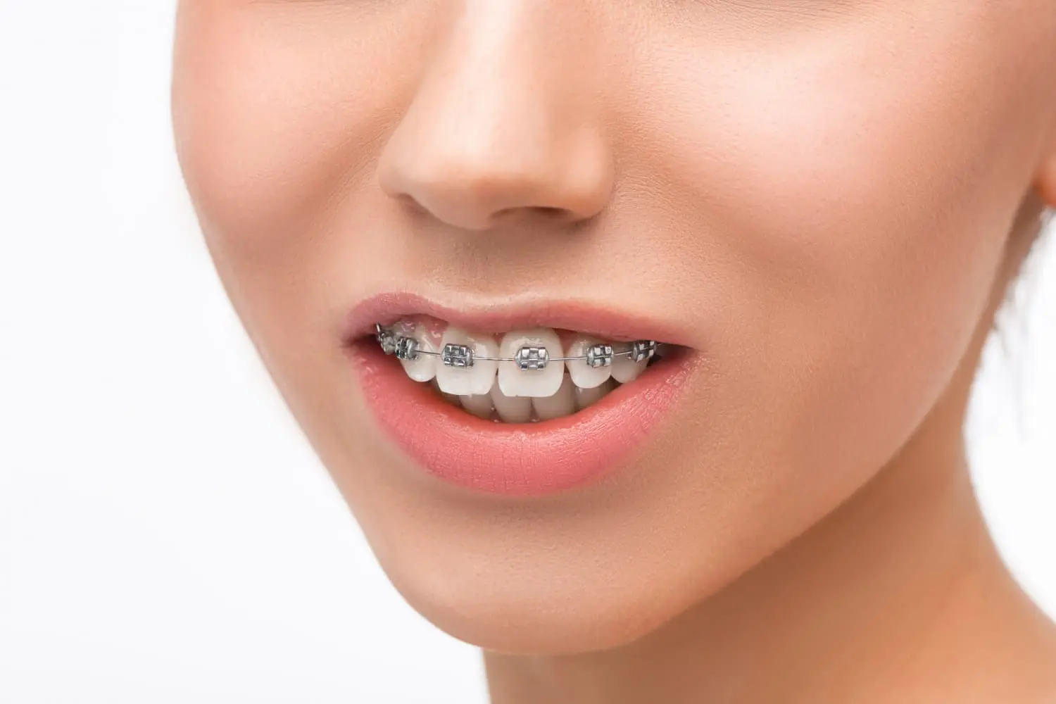 Close-up of a person's mouth with slightly parted lips, revealing metal braces on the upper teeth and a clear overbite. This image is from Jacksonville, FL.