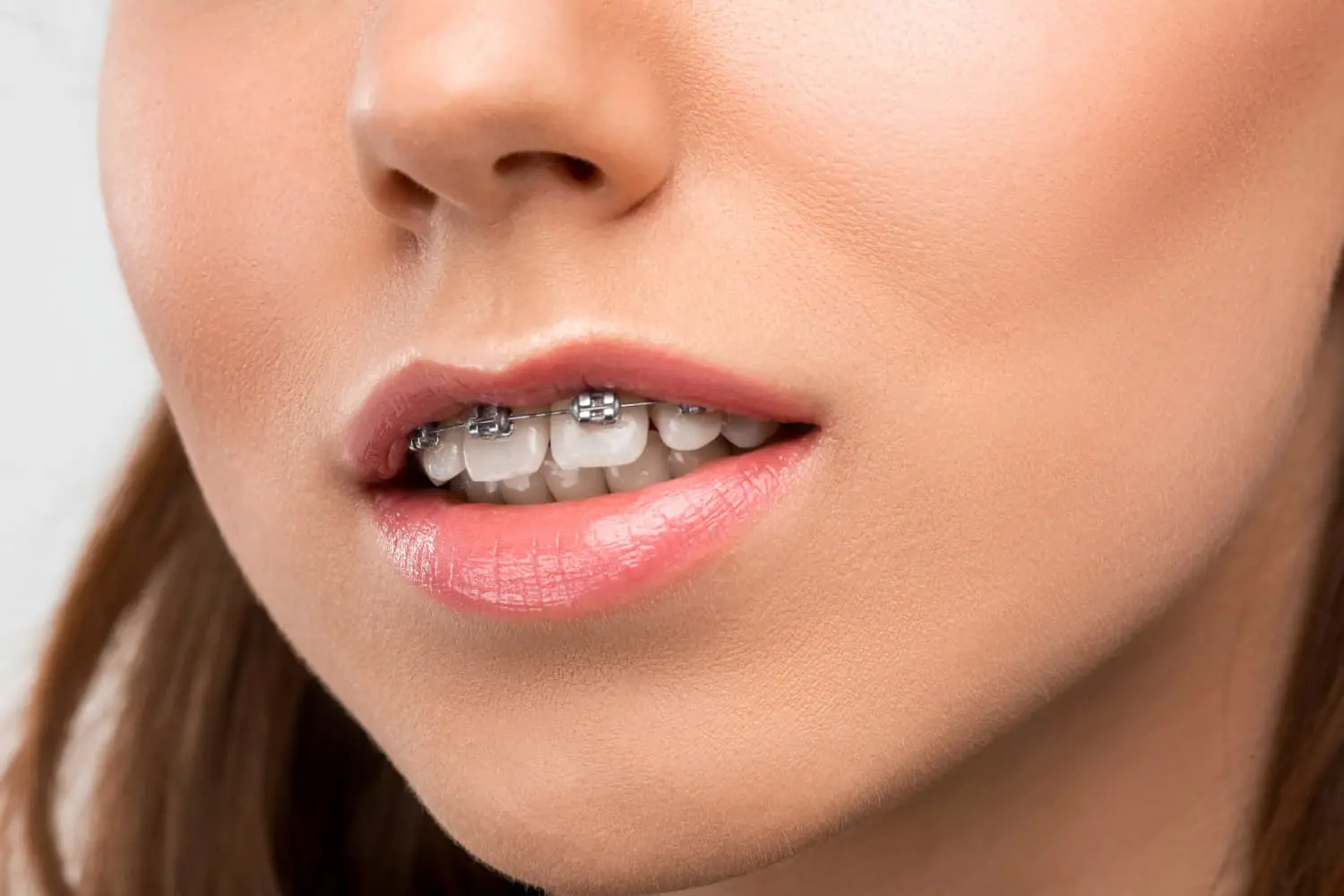 Close-up of a person's slightly open mouth with light pink lips, displaying metal braces on their teeth and a visible overbite. This image is from Jacksonville, FL.