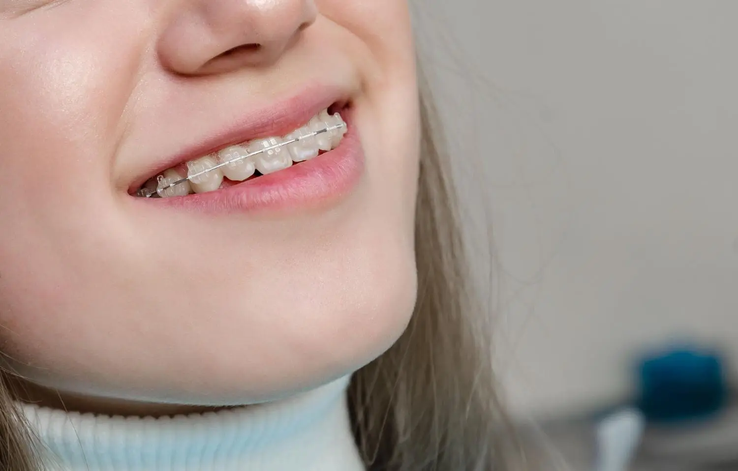Close-up of a person smiling, showing clear ceramic braces on their upper teeth in Jacksonville, FL.