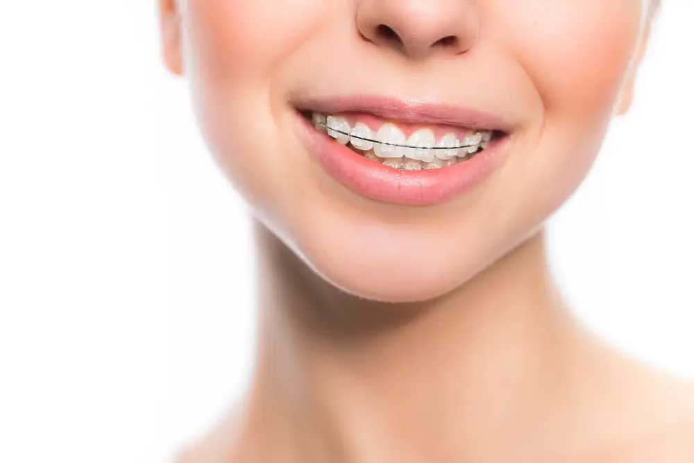 Close-up of a person smiling, showing clear dental braces on their teeth against a white background. Find Braces Near Me in Jacksonville FL for a confident, radiant smile.