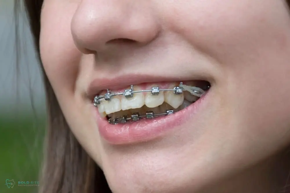 A close-up shows a smiling mouth with metal braces and an orthodontic elastic band at Bold Bite Orthodontics' braces for overbite in Jacksonville, FL.