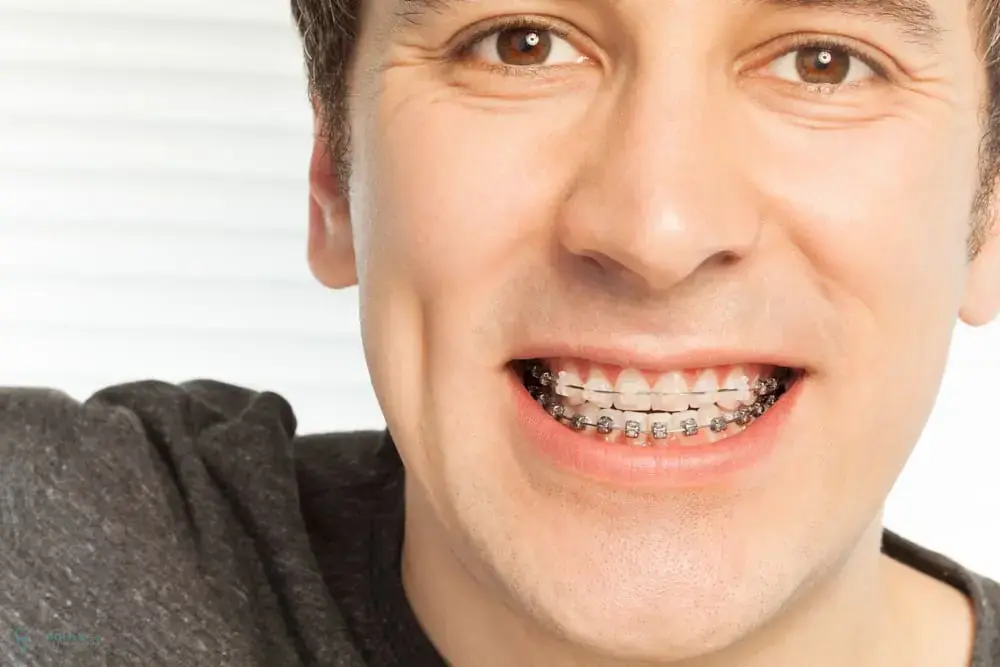 Smiling person with metal braces, dark shirt, light background, promoting Bold Bite Orthodontics in Jacksonville, FL - Overbite vs Underbite in Jacksonville, FL Smiling person with metal braces, dark shirt, light background, promoting Bold Bite Orthodontics in Jacksonville, FL - Overbite vs Underbite in Jacksonville, FL
