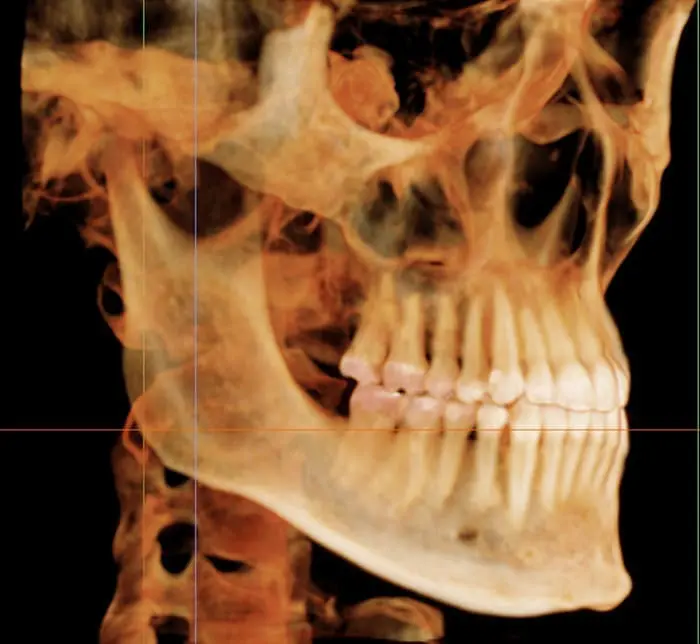 Profile view 3D X-ray of a human skull with detailed teeth and jawbone at Bold Bite Orthodontics in Jacksonville, FL.