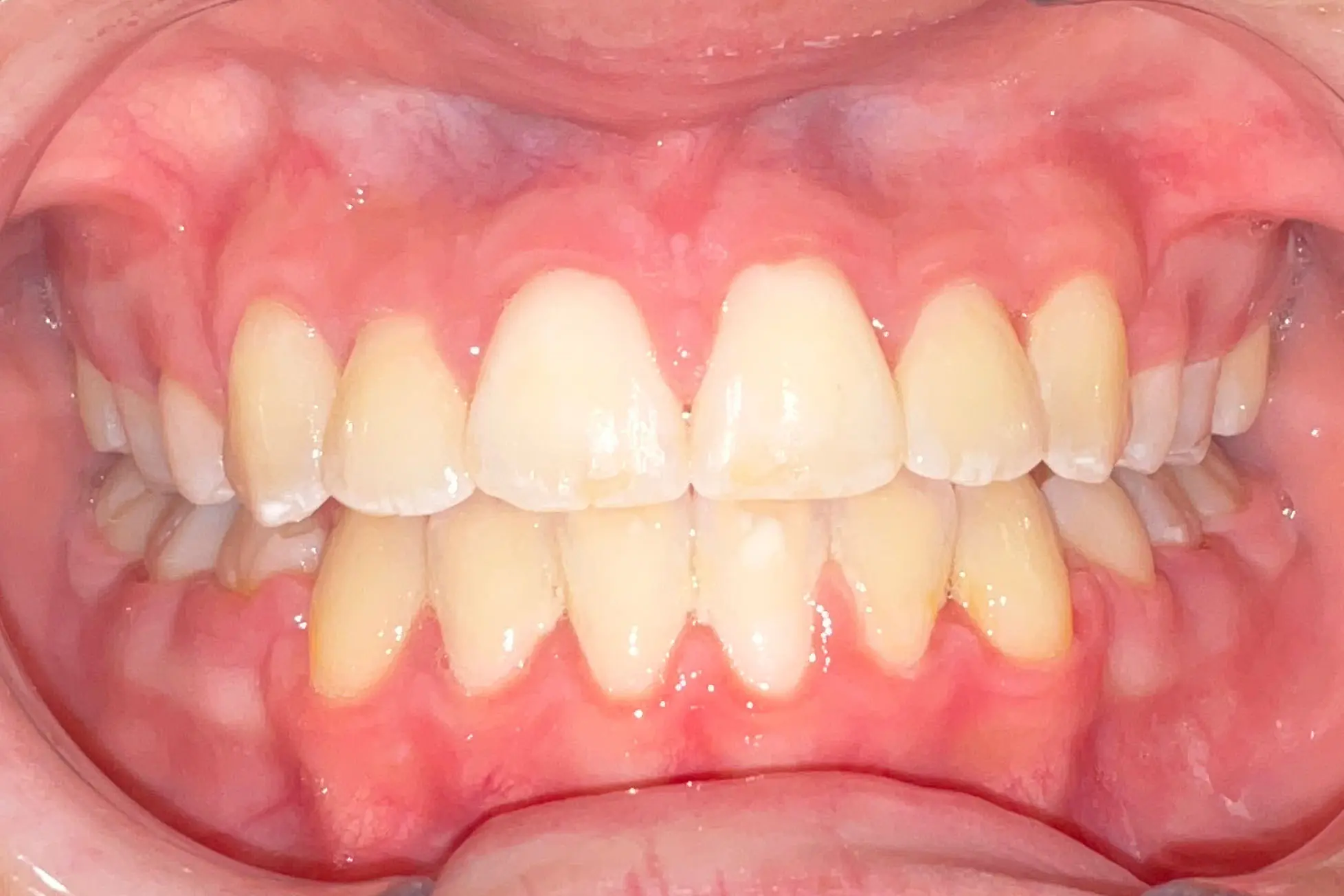 Teeth after braces at Bold Bite Orthodontics in Jacksonville, FL showing mild crowding, overbite, and visible gums.