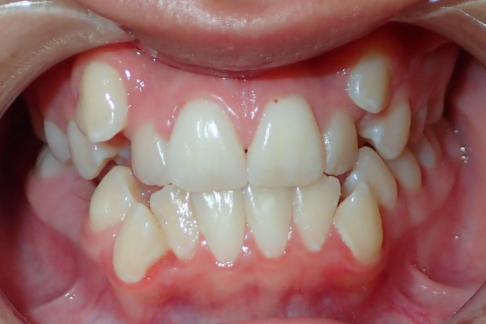Misaligned teeth with crowding and overlap in upper and lower jaws before braces at Bold Bite Orthodontics in Jacksonville, FL.