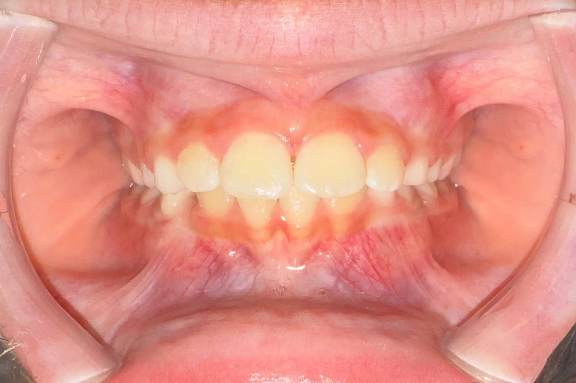 Upper and lower teeth with gums after Angel Aligners at Bold Bite Orthodontics in Jacksonville, FL; cheeks held open by retractors.