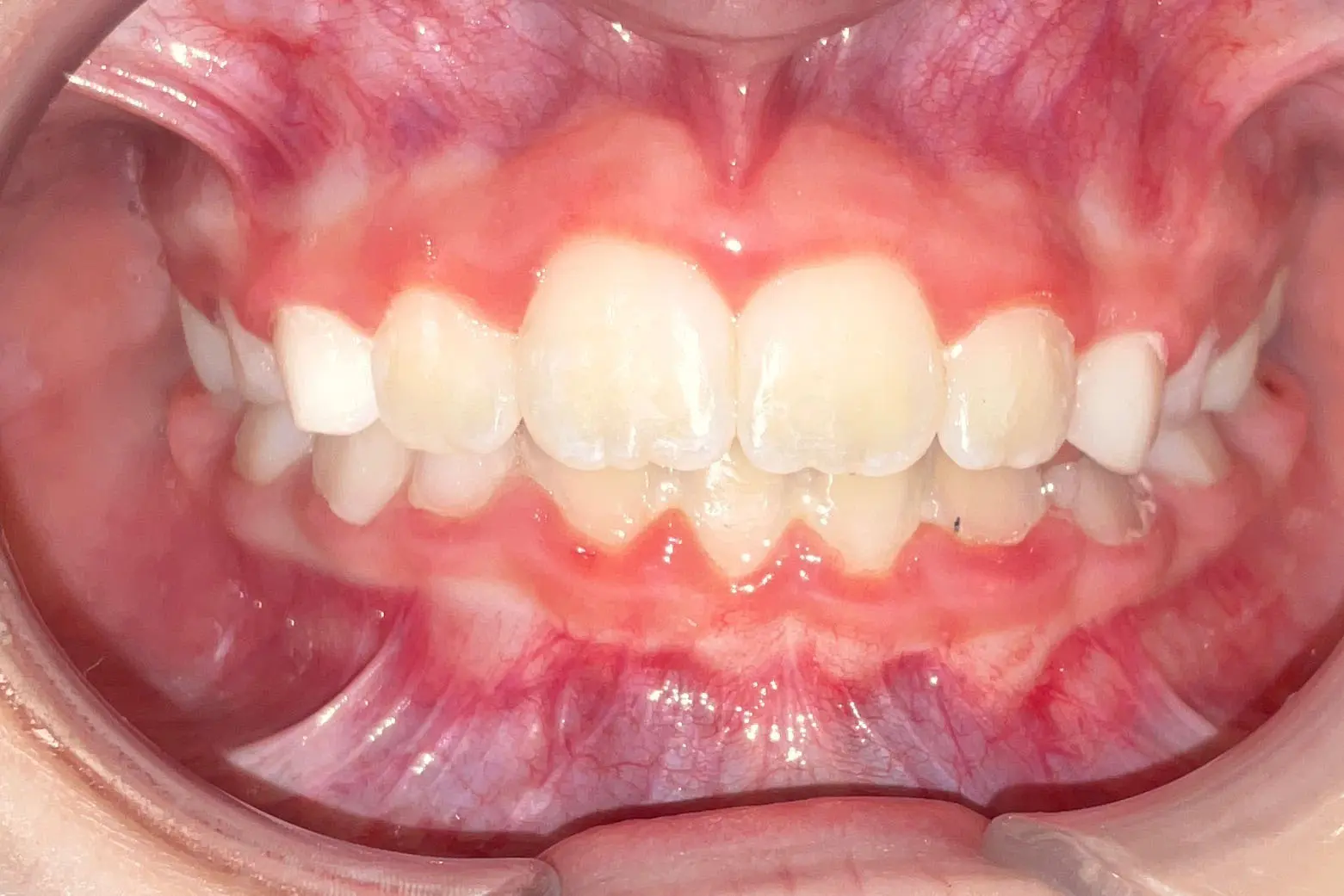 An open mouth shows teeth with mild crowding and visible gums after braces at Bold Bite Orthodontics in Jacksonville, FL.