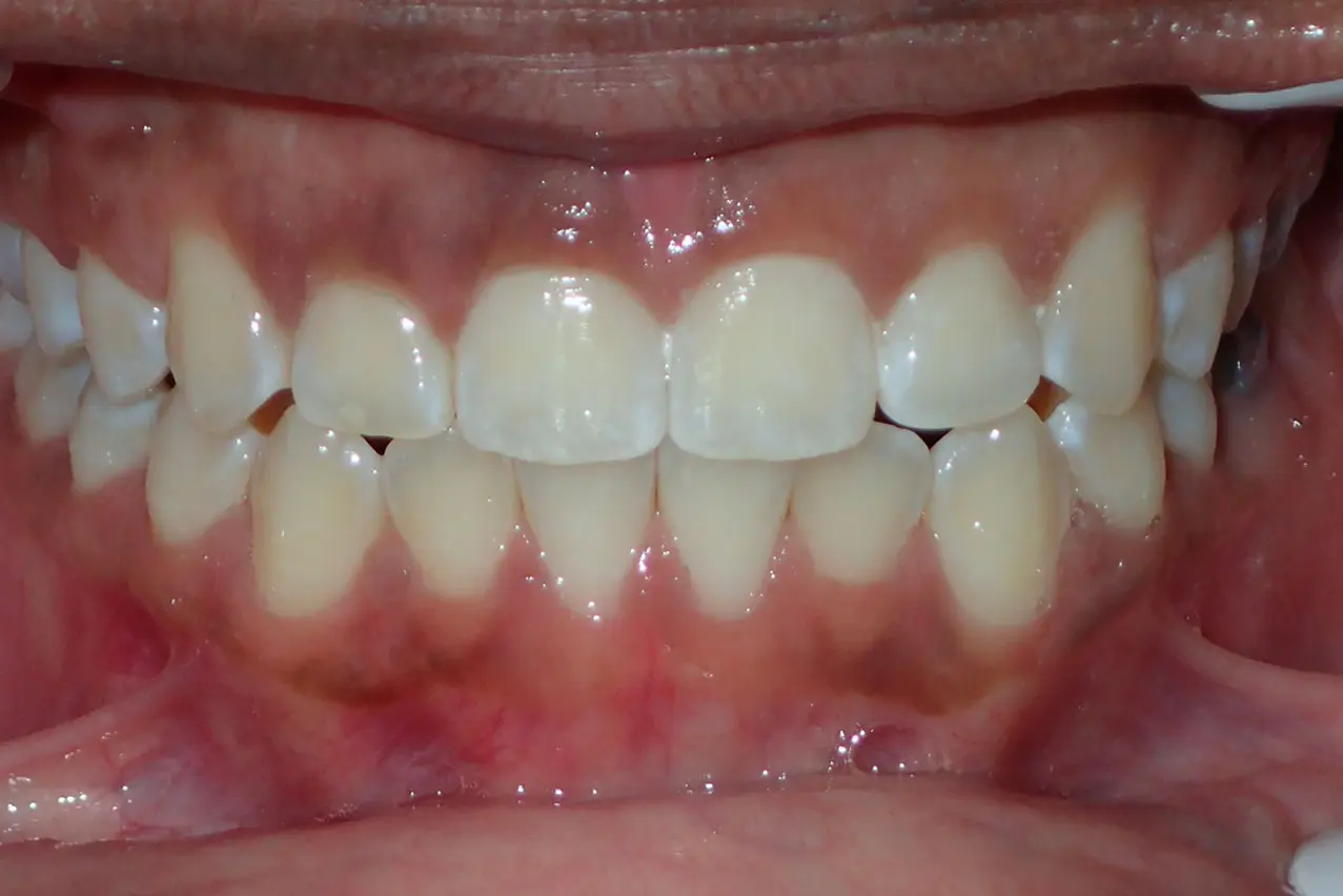 After Invisalign at Bold Bite Orthodontics in Jacksonville, FL: close-up of upper and lower teeth with mild crowding, healthy gums.