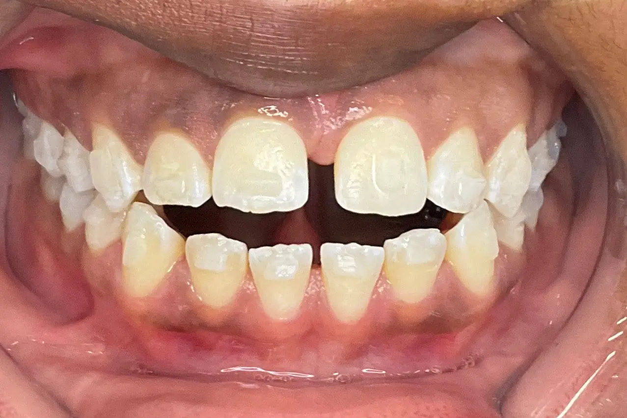 Showing crowded, misaligned teeth with gaps and white spots before Invisalign at Bold Bite Orthodontics in Jacksonville, FL.